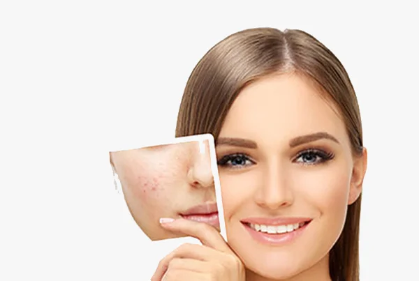 Acne Problems